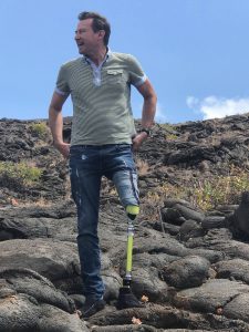 Prothesenknie VGK-Short Transfemoral Raul Pallares